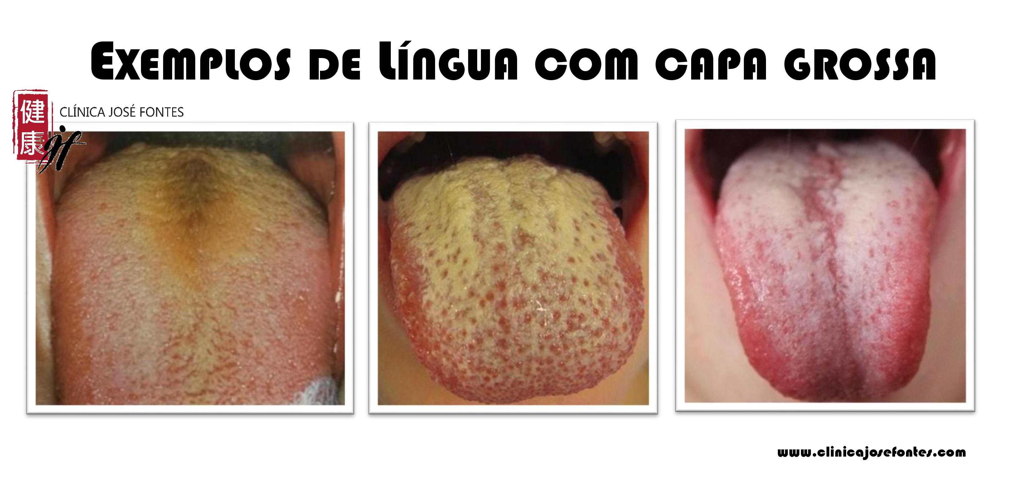língua branca com capa grossa
