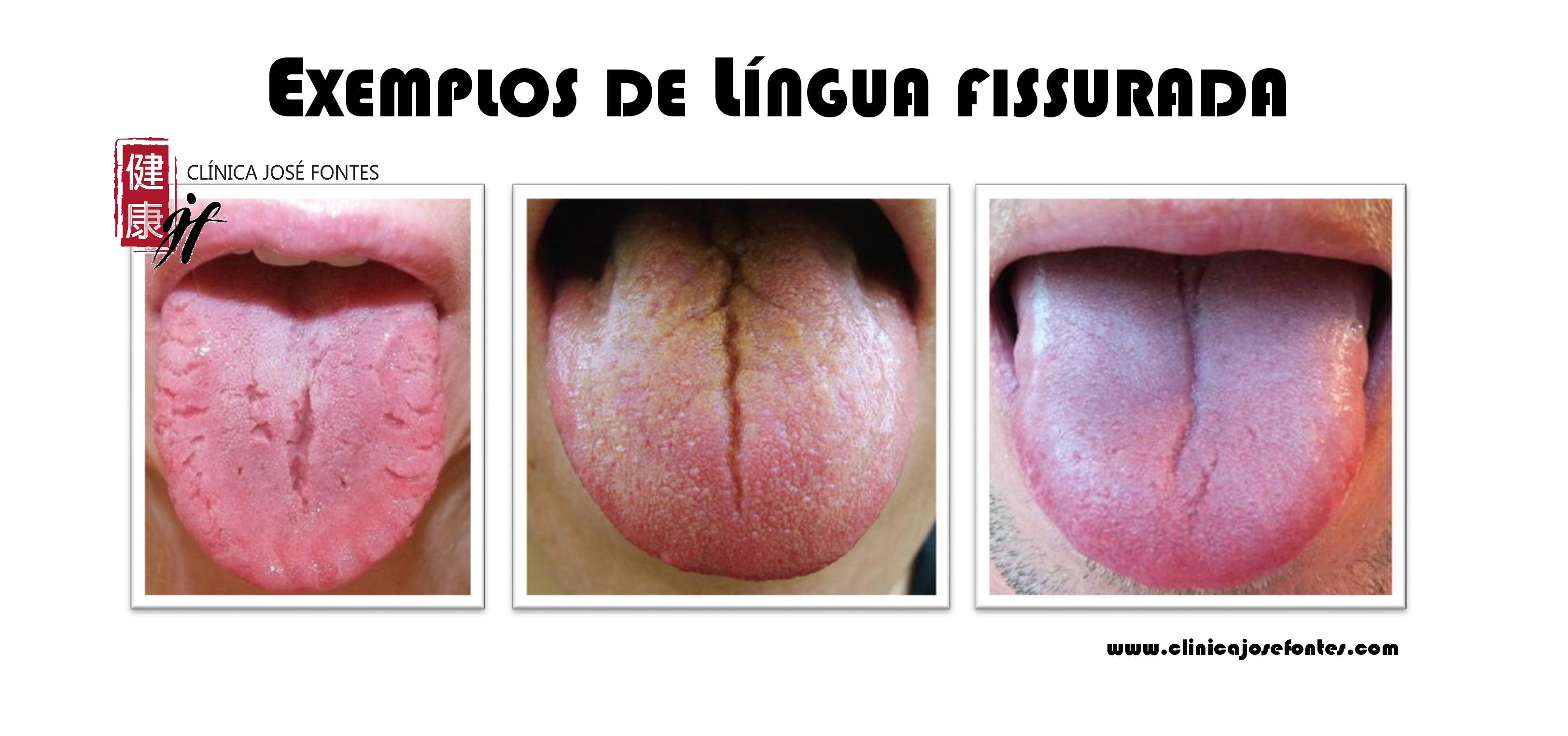 língua fissurada