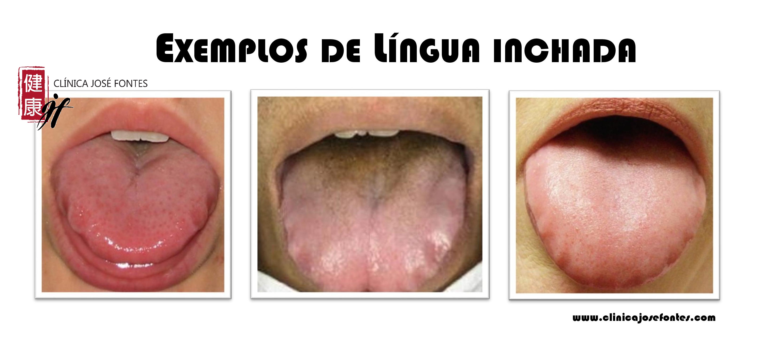 língua inchada