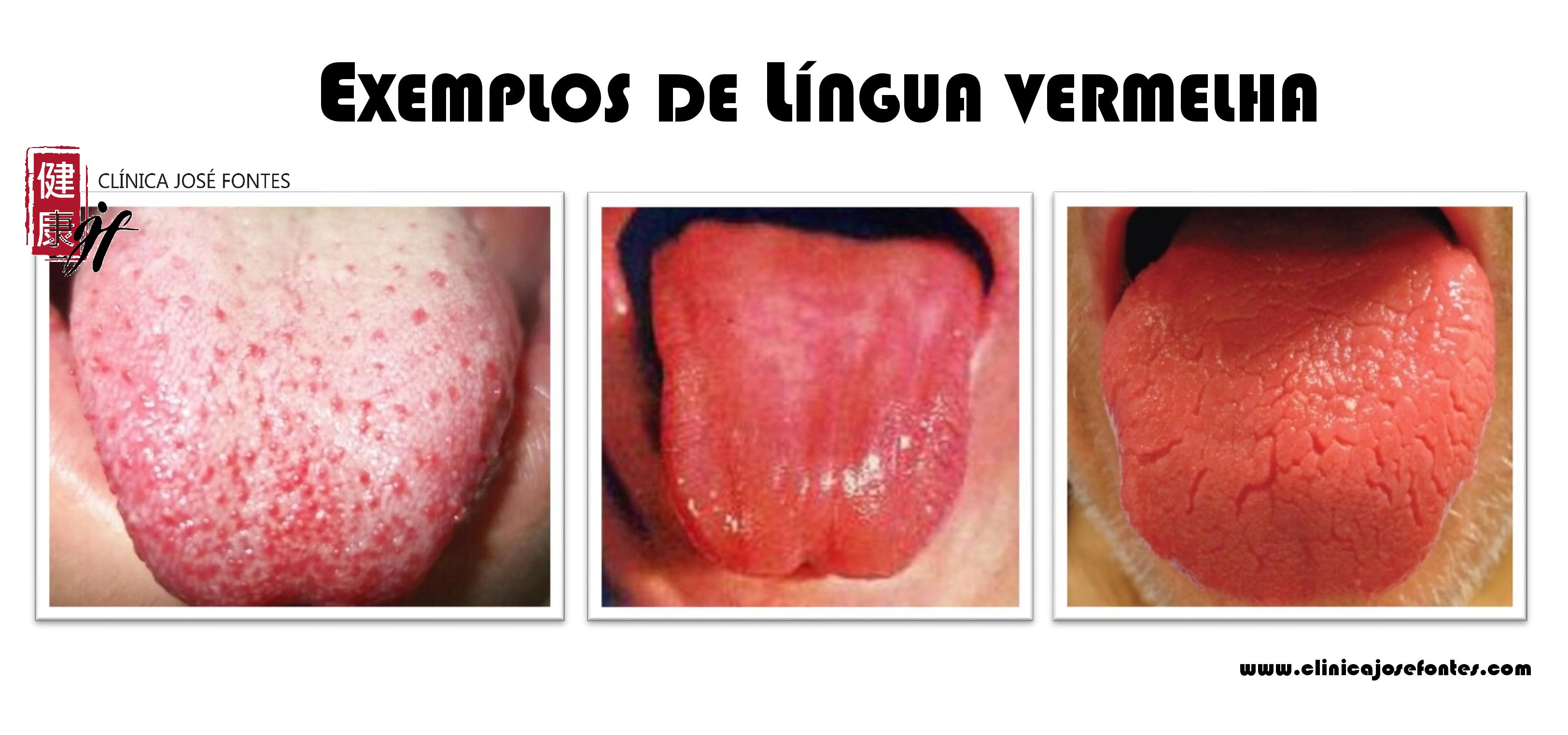 língua vermelha