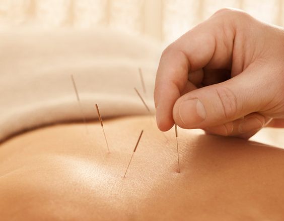 Acupuntura vs Acupuntura médica