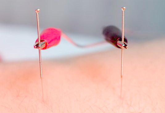 eletroacupuntura