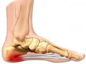 fasceite plantar tratamento