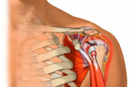 tendinite ombro tratamento
