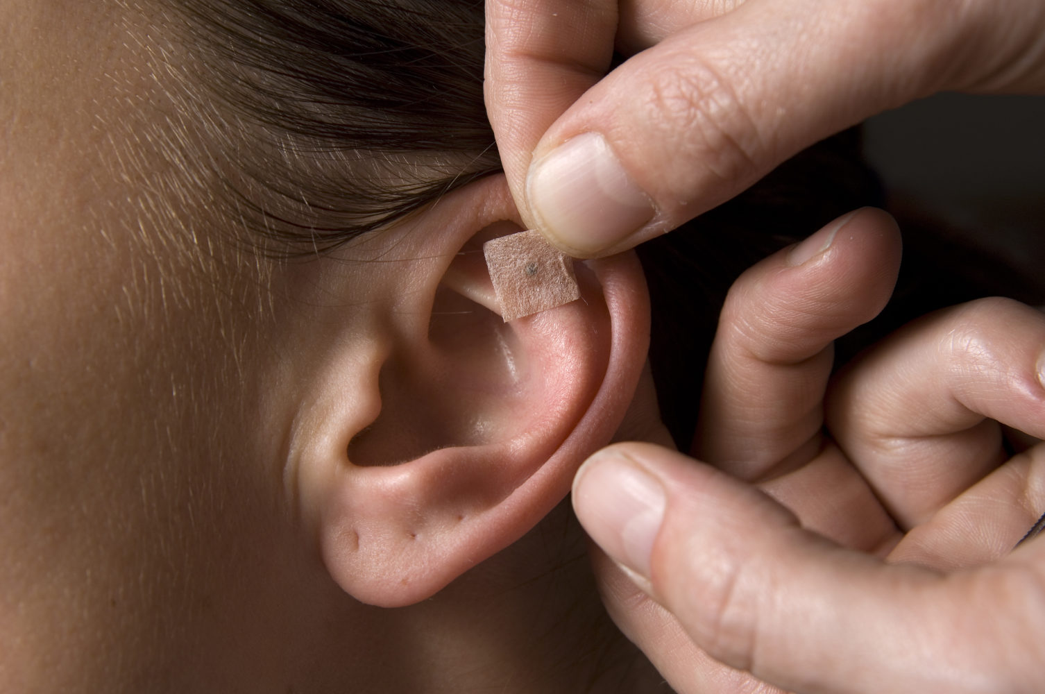 Auriculoterapia