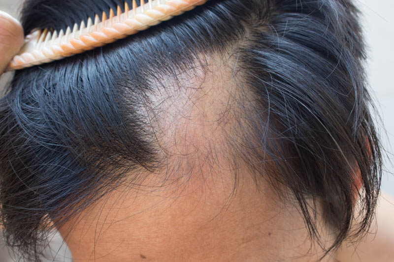Queda de Cabelo – Alopecia