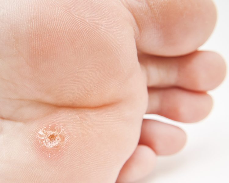Papiloma Vírico (VPH) ou Verruga plantar