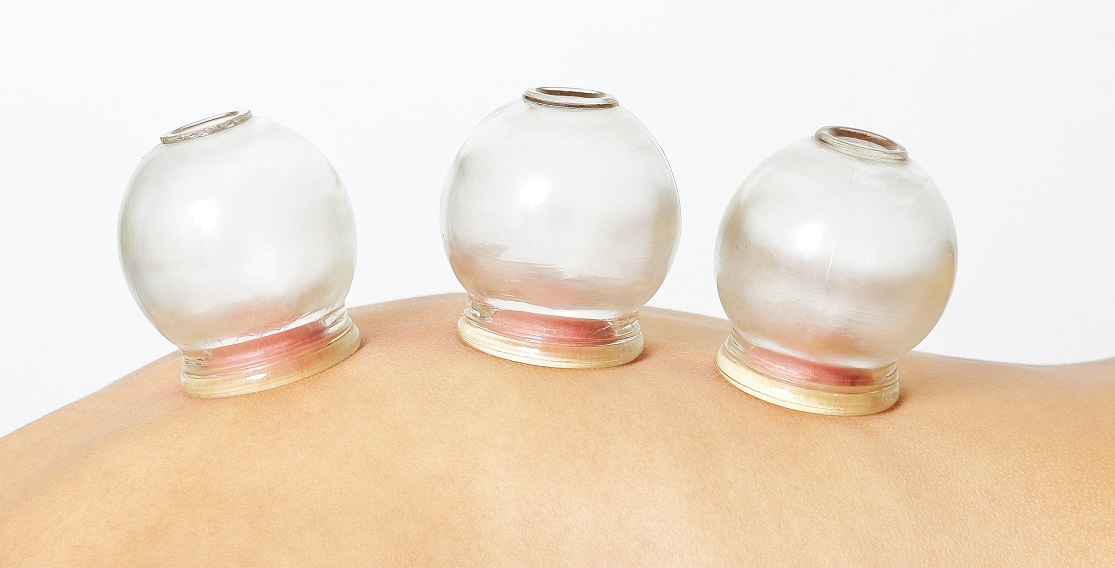 cupping therapy ventosaterapia